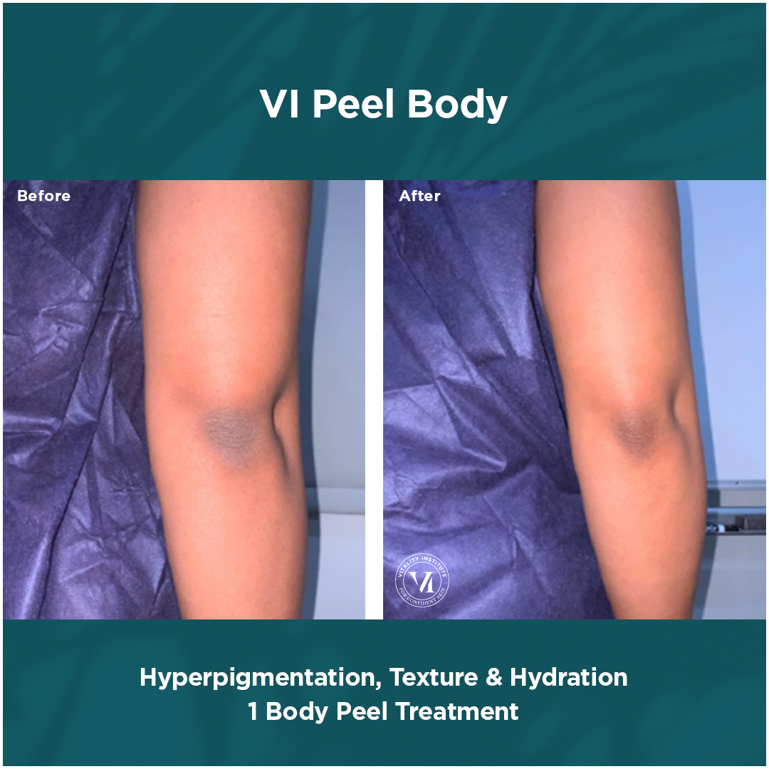 Hyperpigmentation Texture