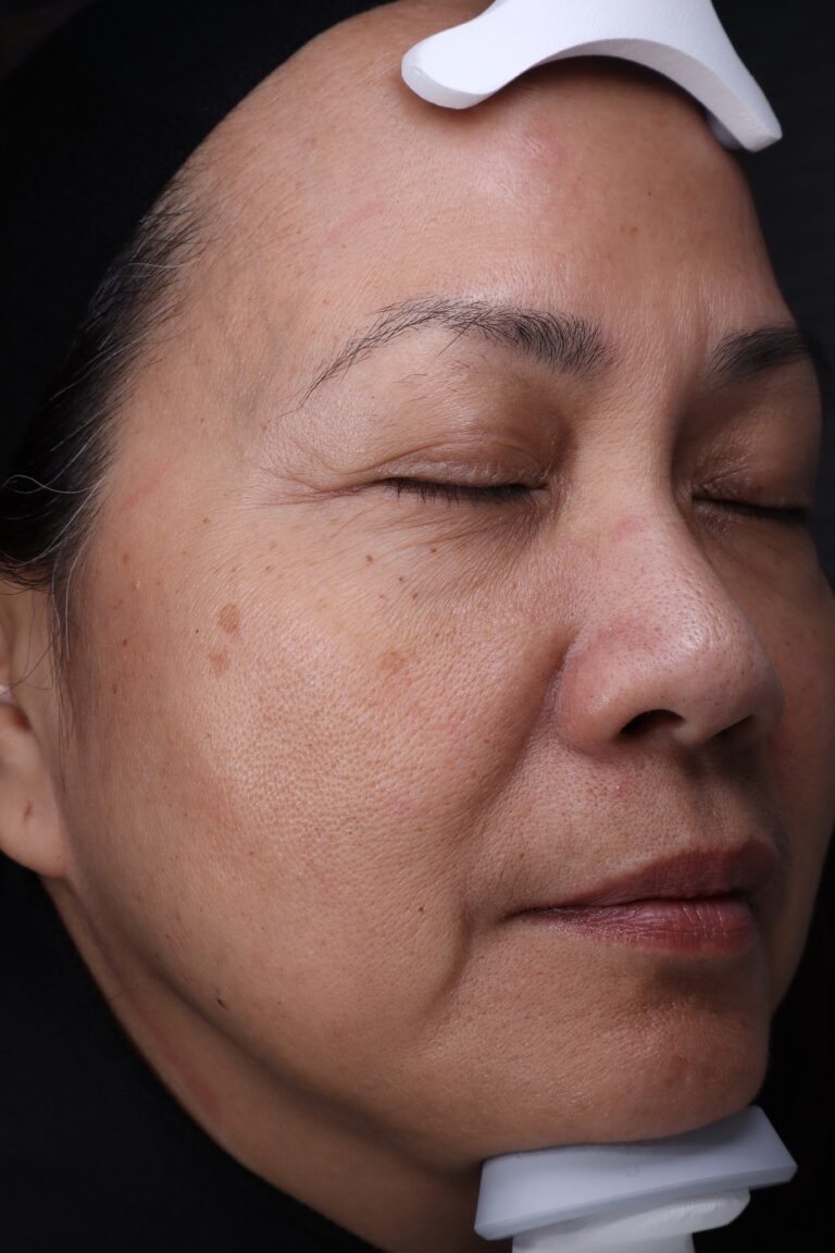 Before Image: BBL+MOXI Combination treatment - right-front-oblique