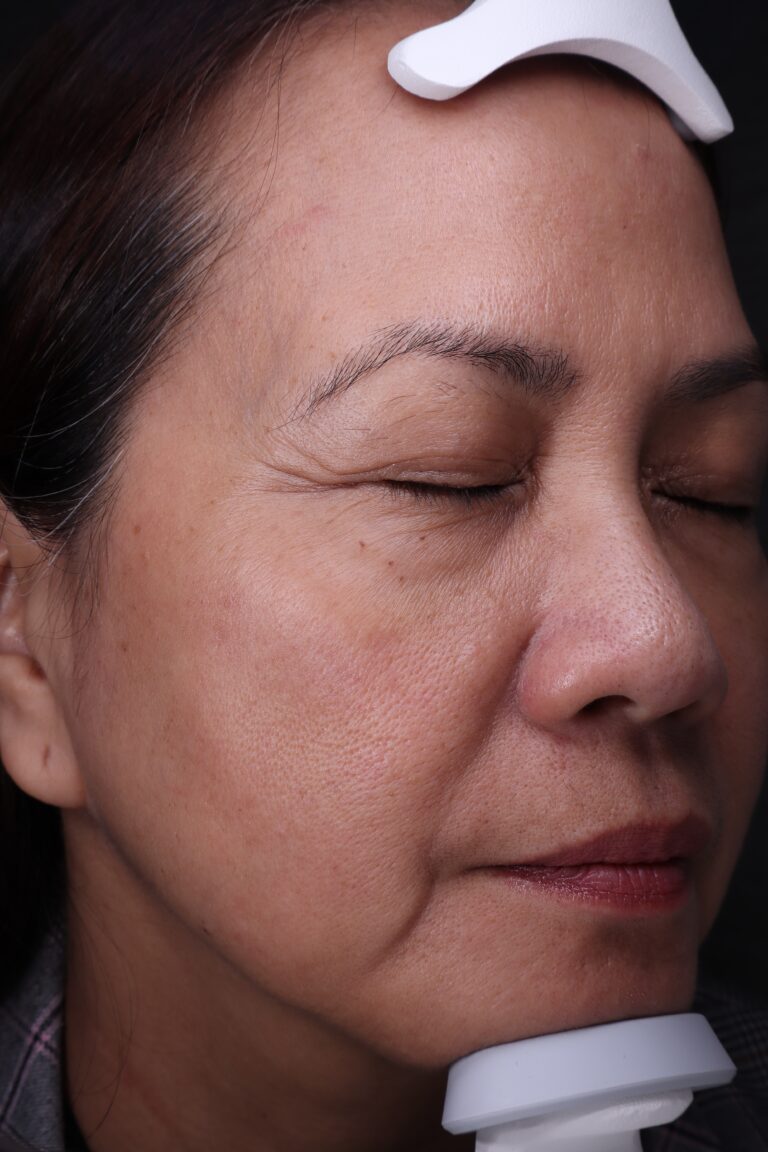 After Image: BBL+MOXI Combination treatment - right-front-oblique