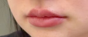 After Image: Restylane Kysse Lip Filler