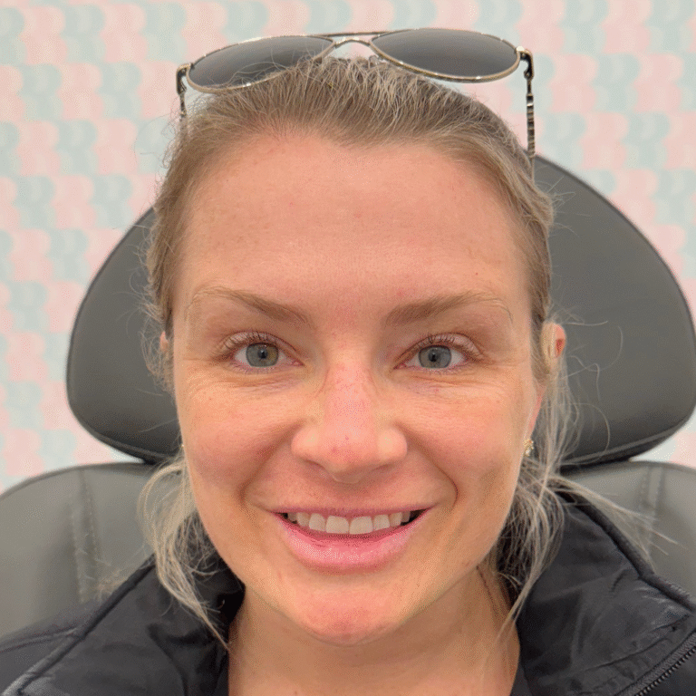 After Image: Botox - front