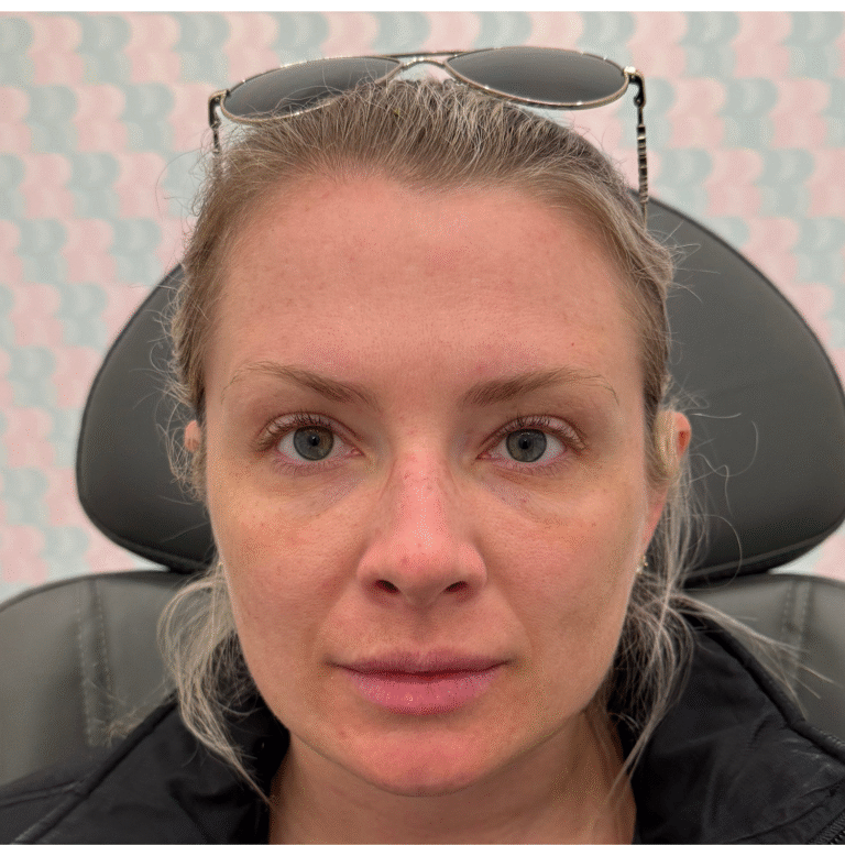 After Image: Botox - front