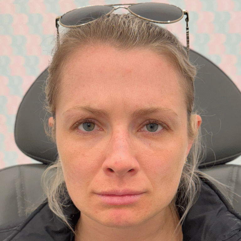 After Image: Botox - front