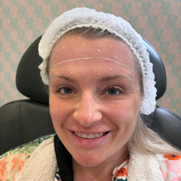 Before Image: Botox - front