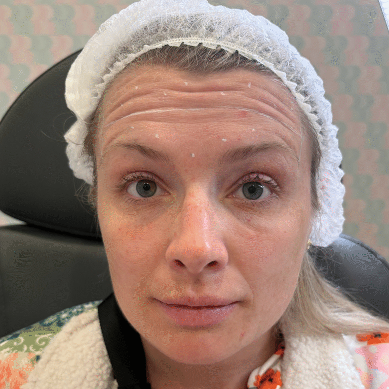 Before Image: Botox - front