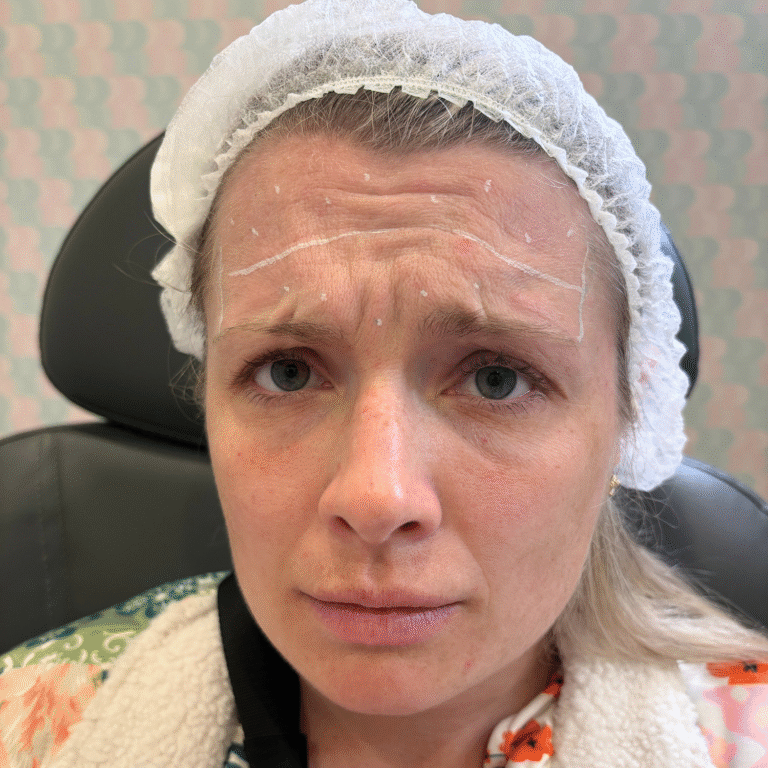 Before Image: Botox - front