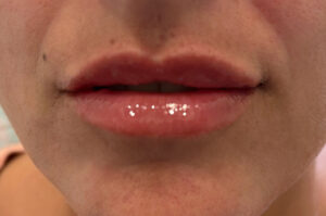 After Image: Restylane Kysse Lip Filler