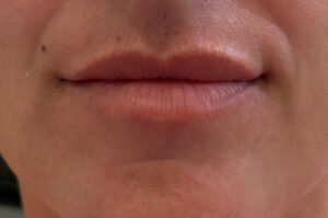 Before Image: Restylane Kysse Lip Filler