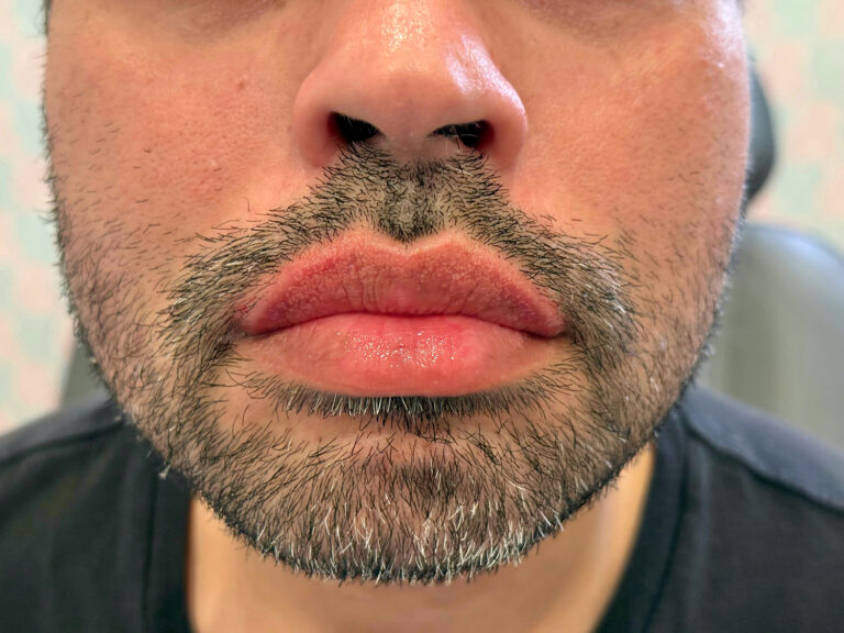 After Image: Restylane Kysse Lip Filler - front