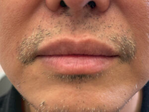 After Image: Restylane Kysse Lip Filler