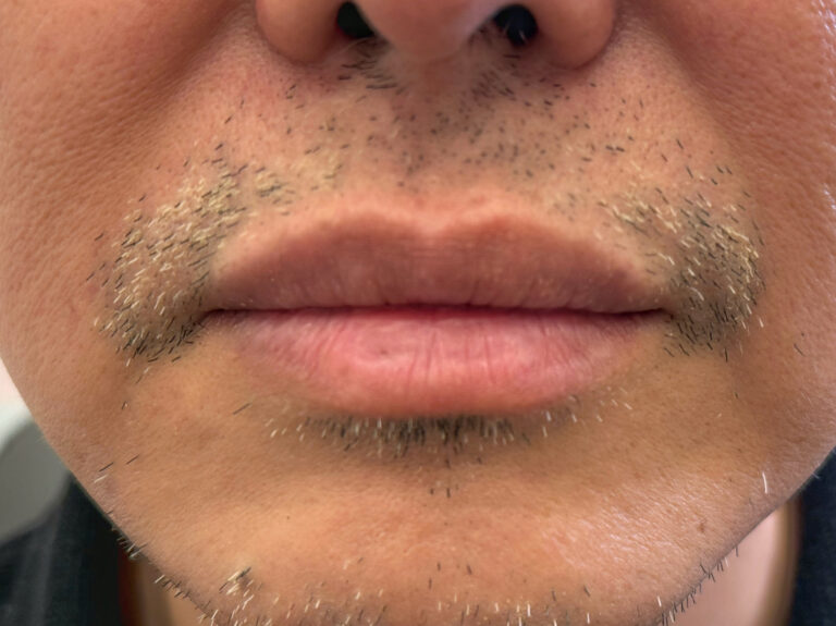 After Image: Restylane Kysse Lip Filler - front