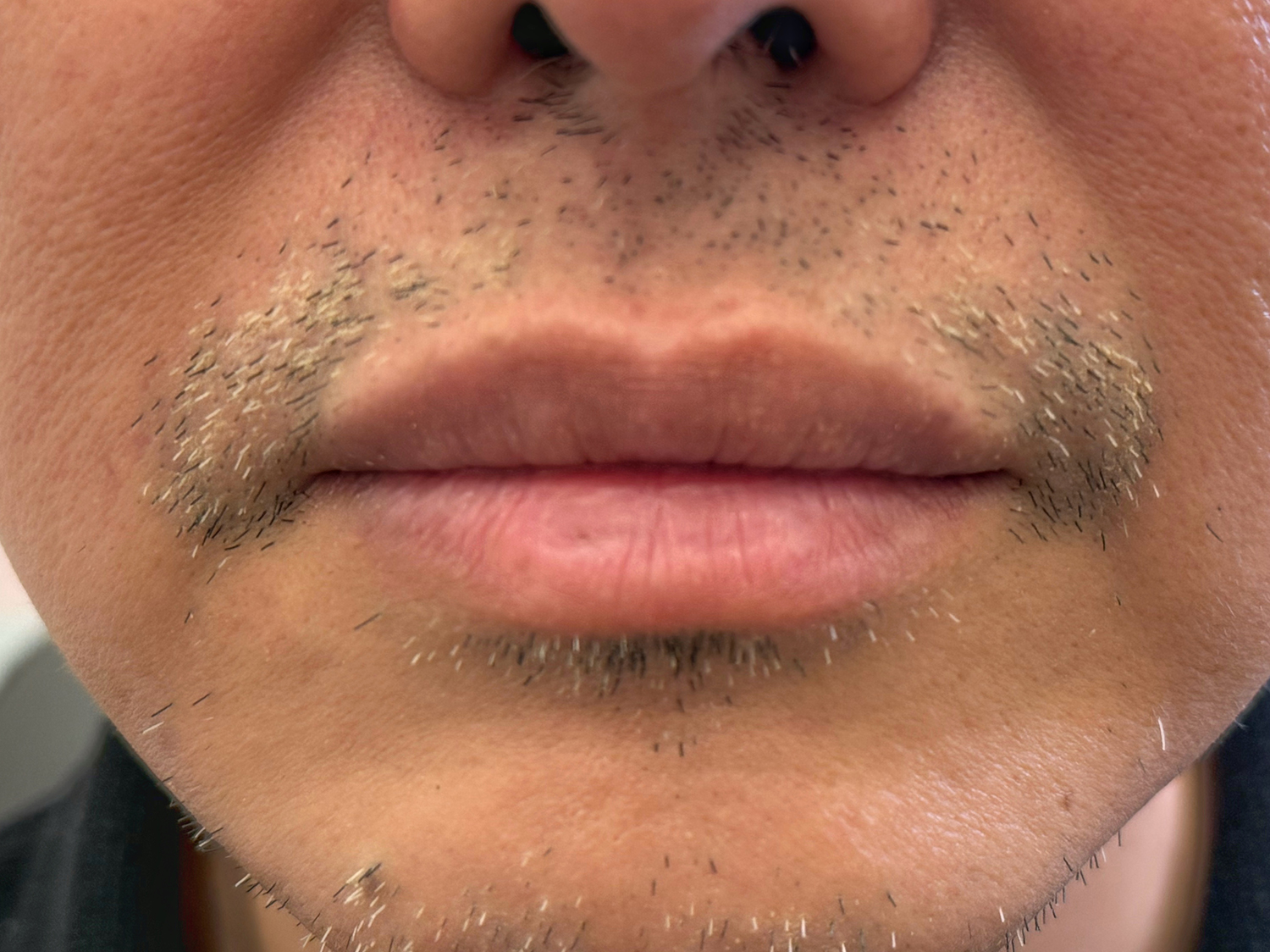 After Image: Restylane Kysse Lip Filler - front