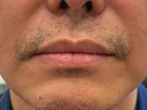 Before Image: Restylane Kysse Lip Filler
