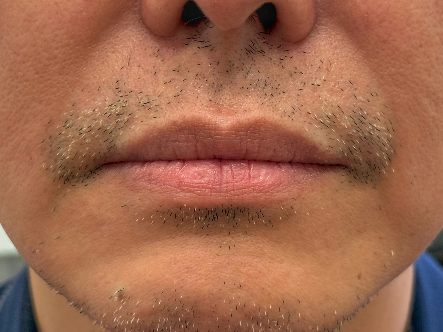 Before Image: Restylane Kysse Lip Filler - front