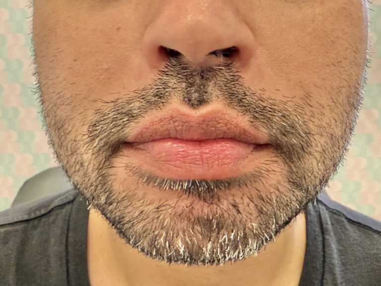Before Image: Restylane Kysse Lip Filler - front