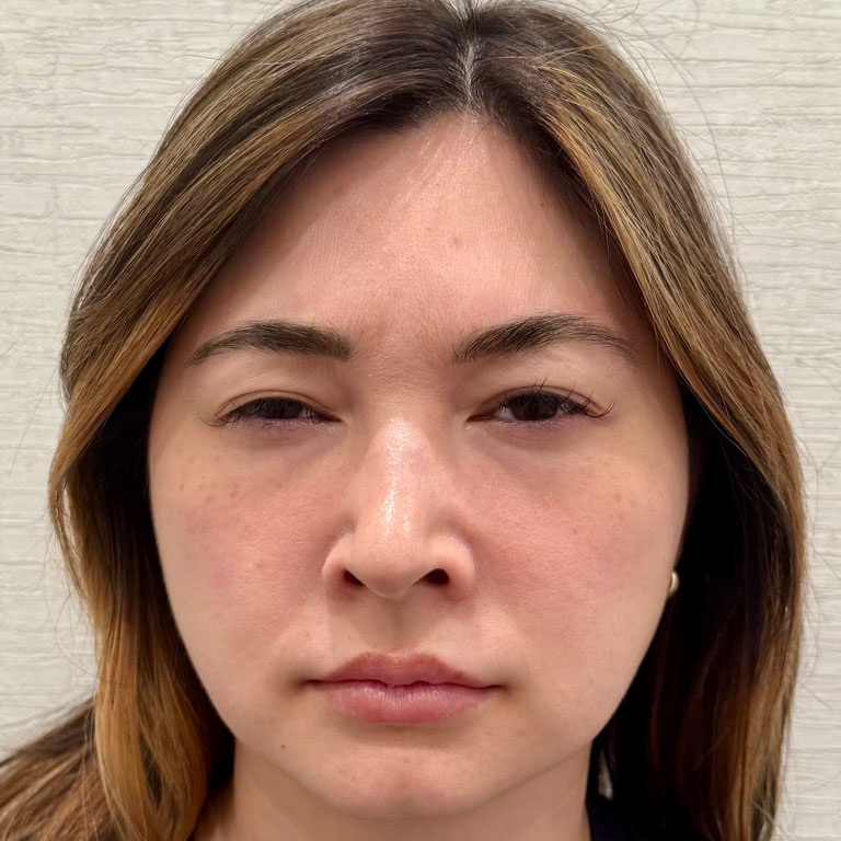 After Image: Xeomin - front