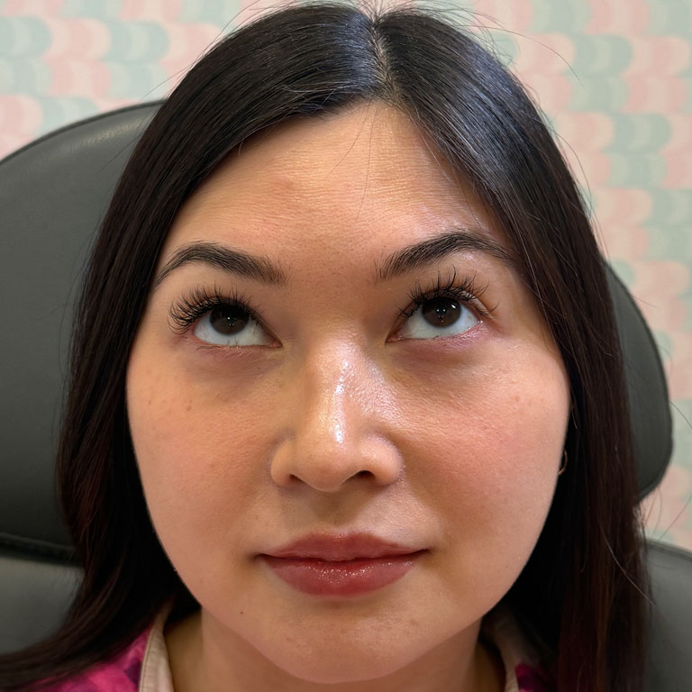 Before Image: Xeomin - front