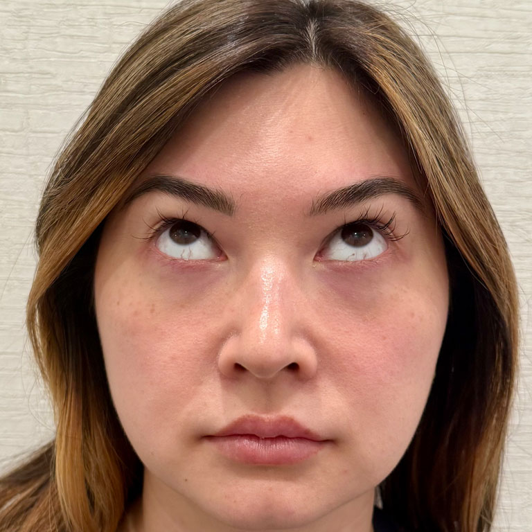 After Image: Xeomin - front