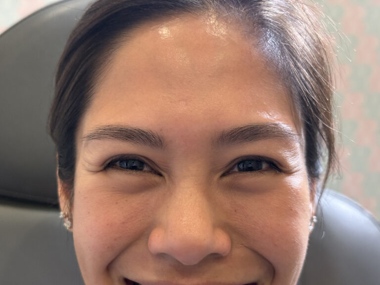 Before Image: Xeomin – Crow’s Feet - front