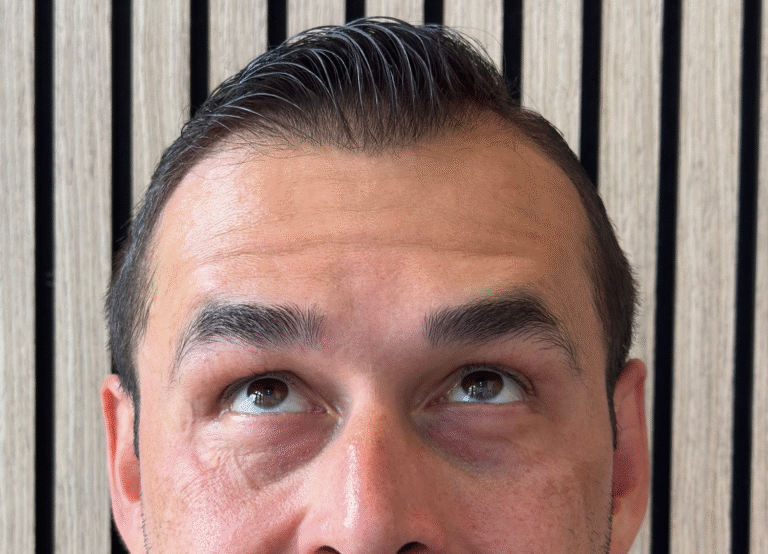 After Image: Xeomin - front