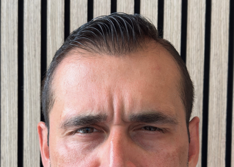 After Image: Xeomin - front