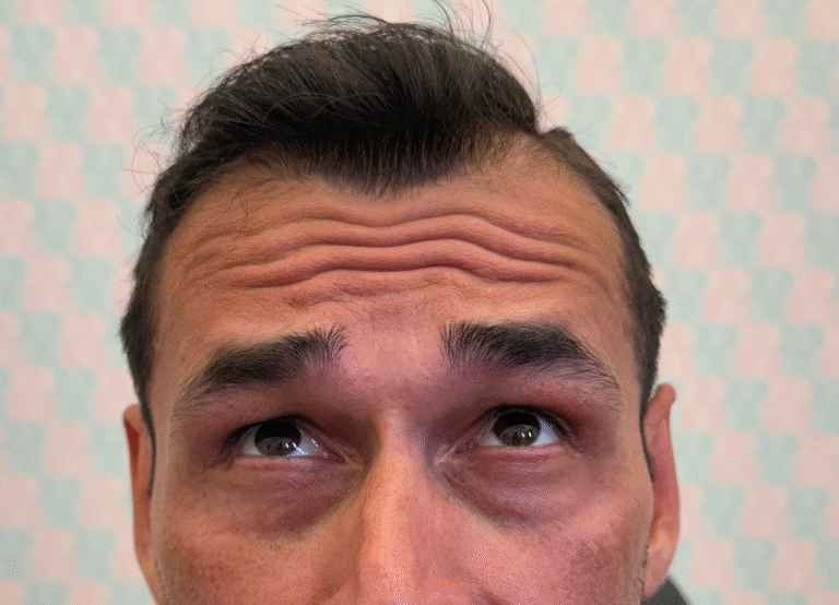 Before Image: Xeomin - front