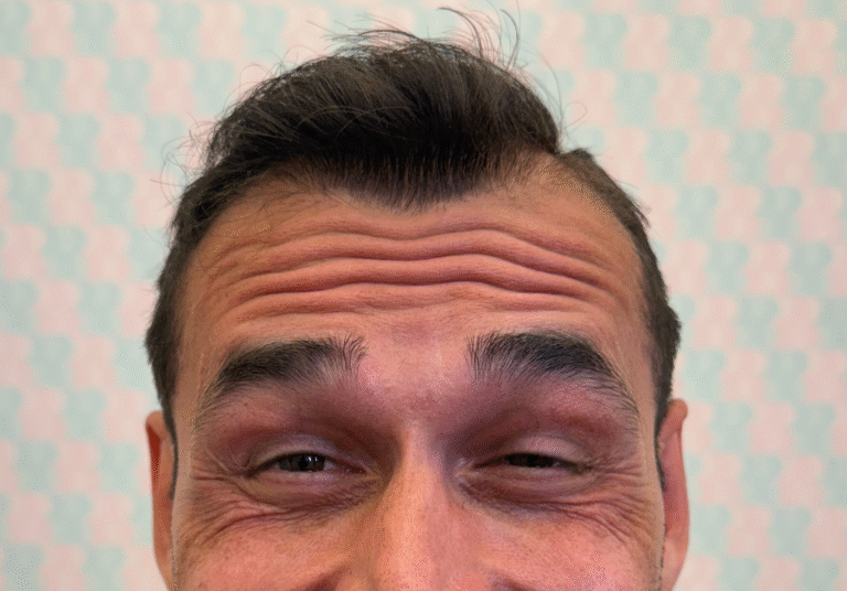 Before Image: Xeomin - front