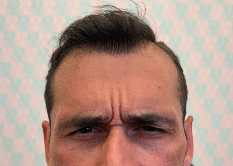 Before Image: Xeomin - front