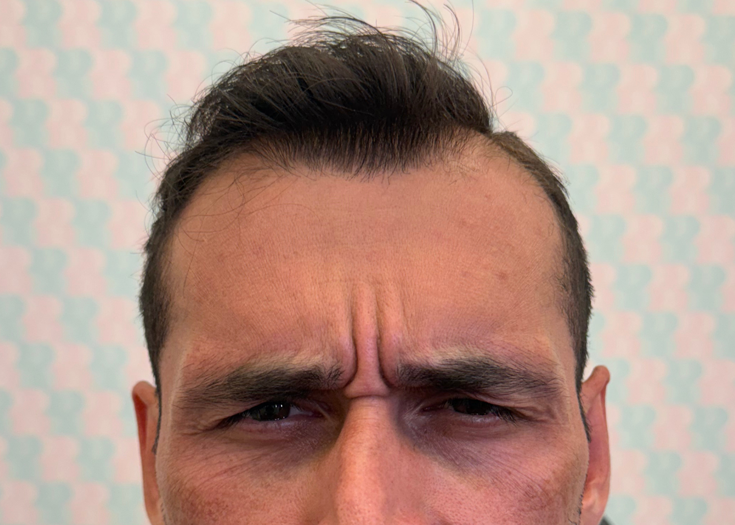 Before Image: Xeomin - front