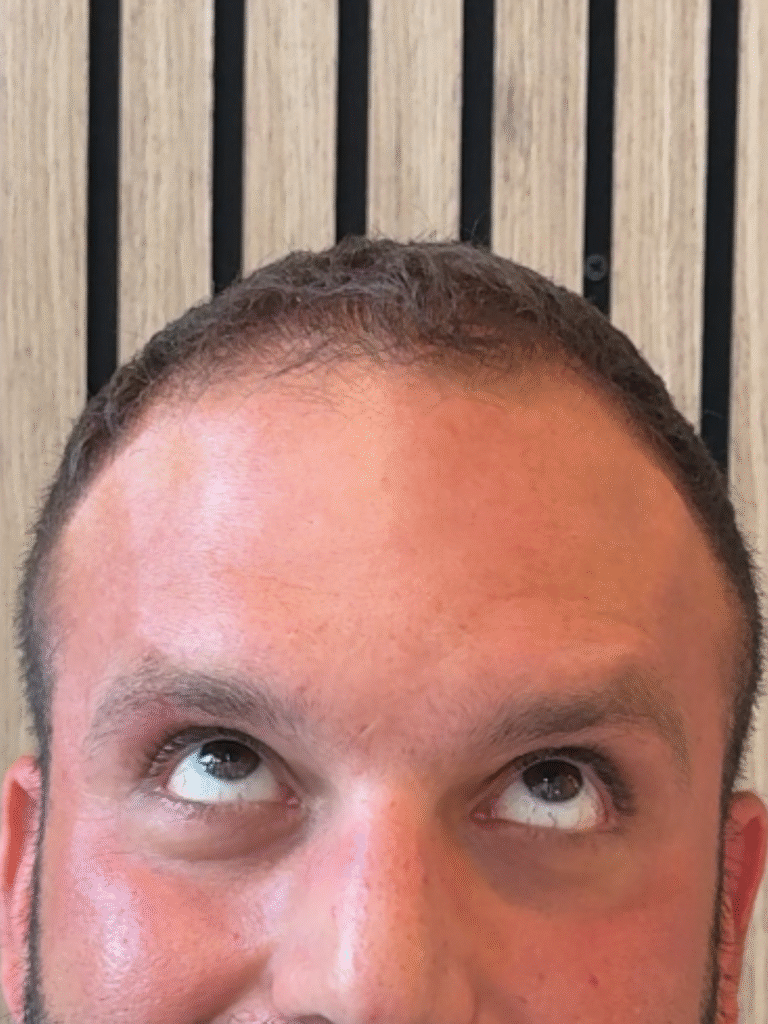 After Image: Xeomin - front