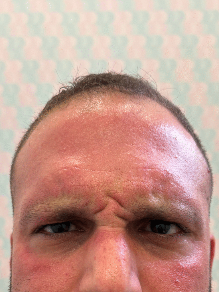 Before Image: Xeomin - front