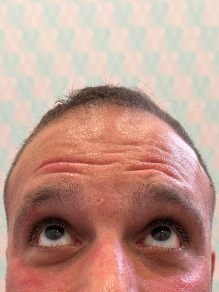 Before Image: Xeomin - front