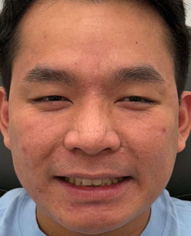 After Image: Xeomin - front