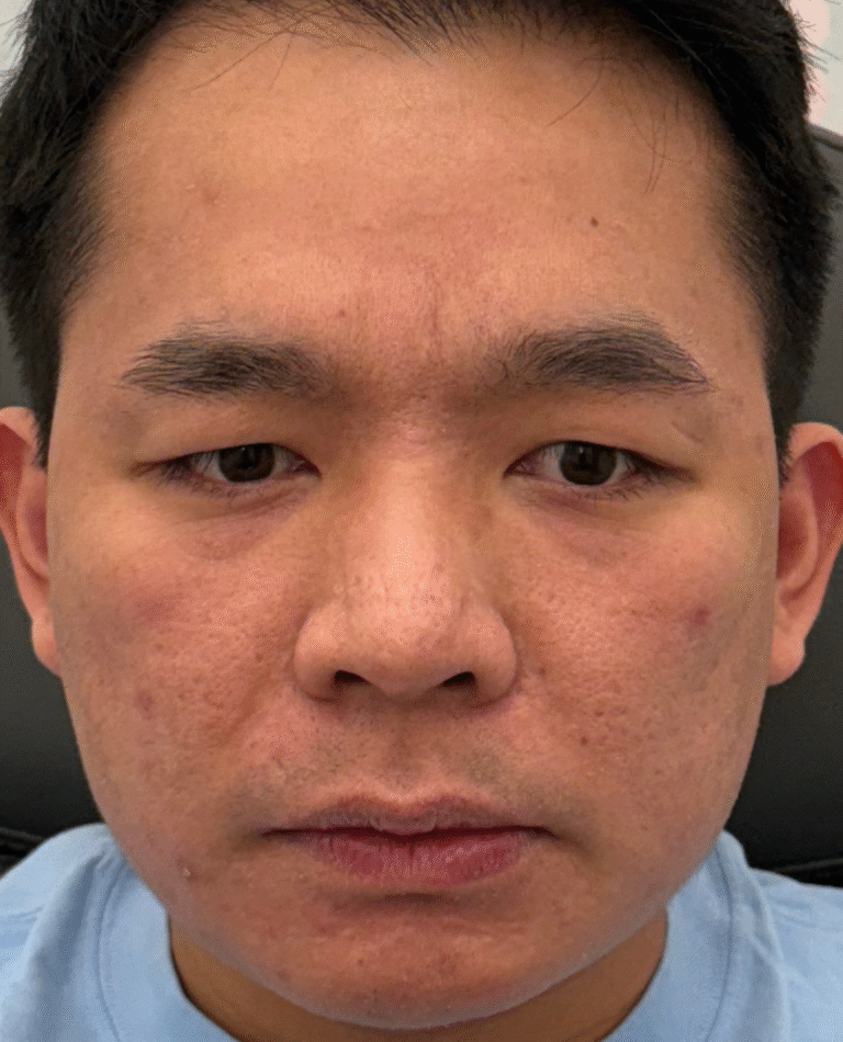 After Image: Xeomin - front