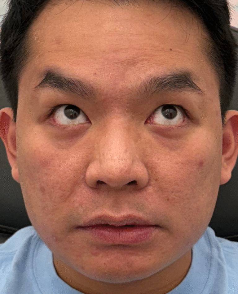 After Image: Xeomin - front