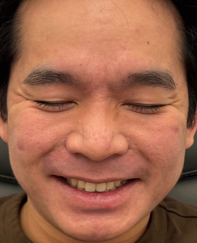 Before Image: Xeomin - front