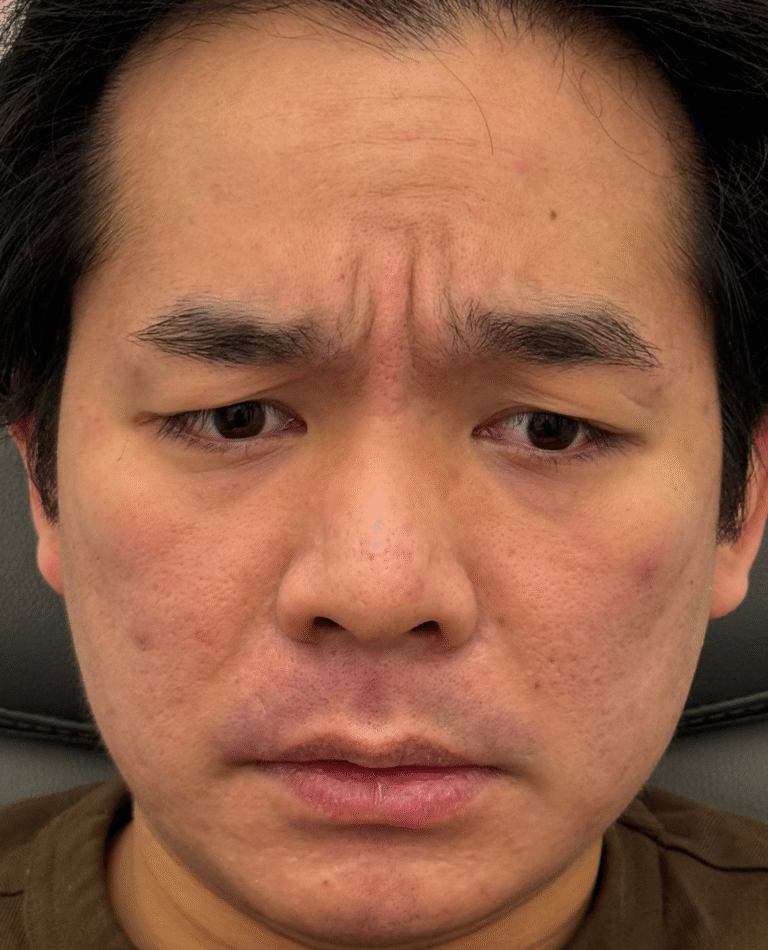 Before Image: Xeomin - front