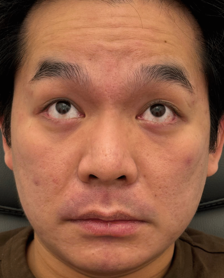 Before Image: Xeomin - front