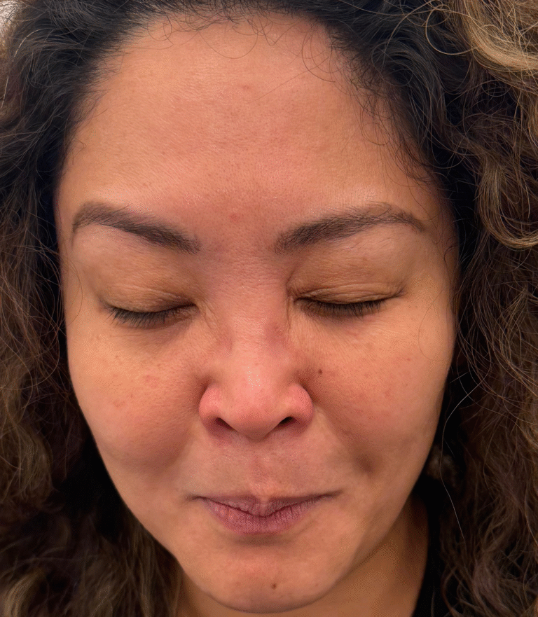 After Image: Xeomin - front