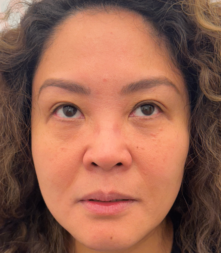 After Image: Xeomin - front