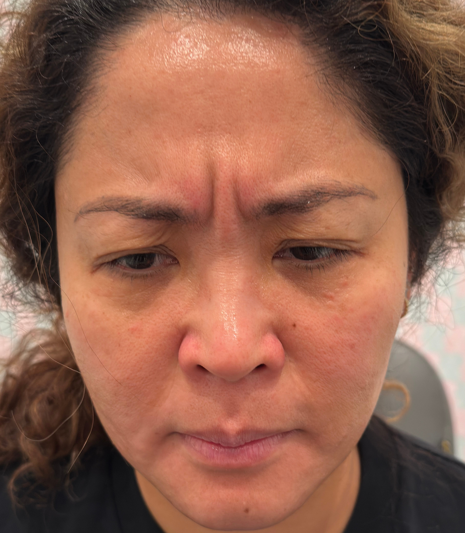 Before Image: Xeomin - front