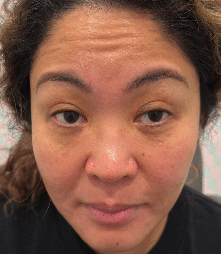 Before Image: Xeomin - front