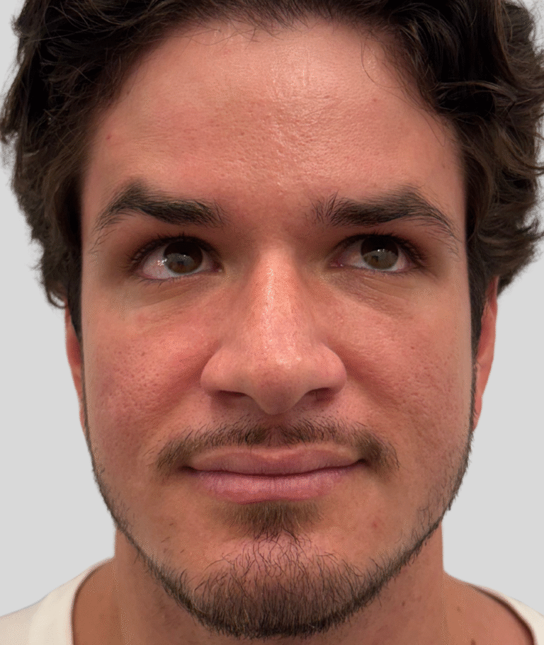 After Image: Xeomin - front