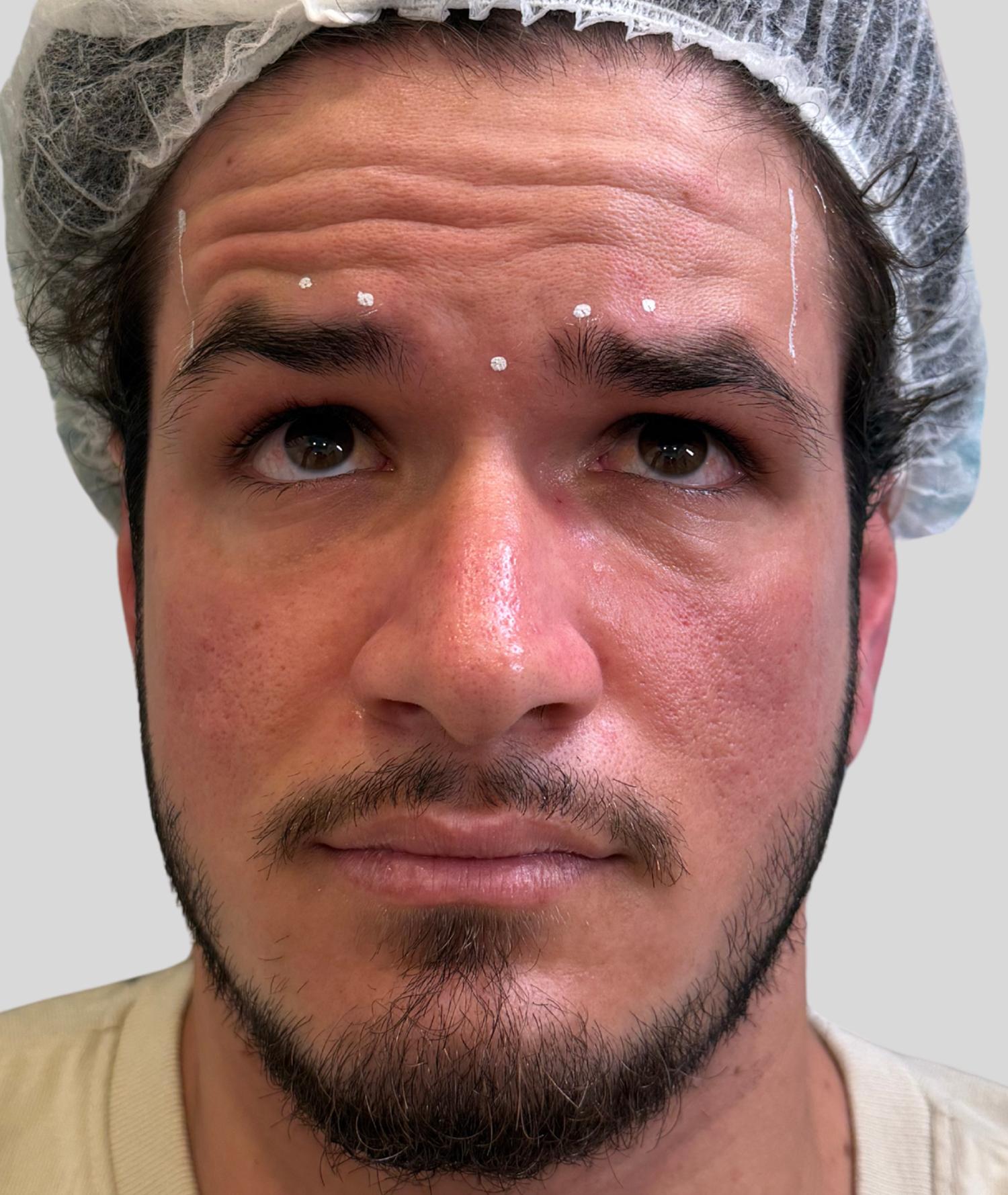 Before Image: Xeomin - front