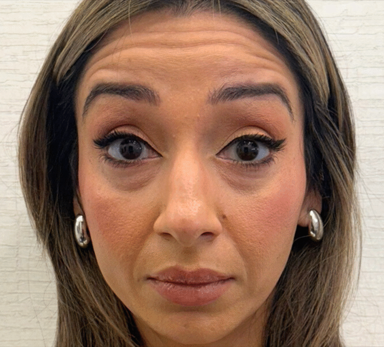 Before Image: Xeomin - front