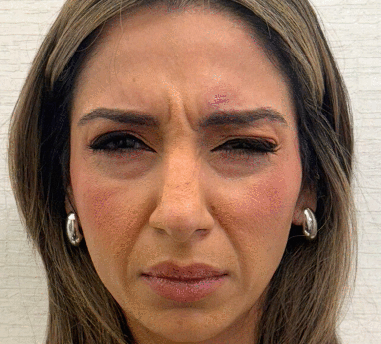 Before Image: Xeomin - front