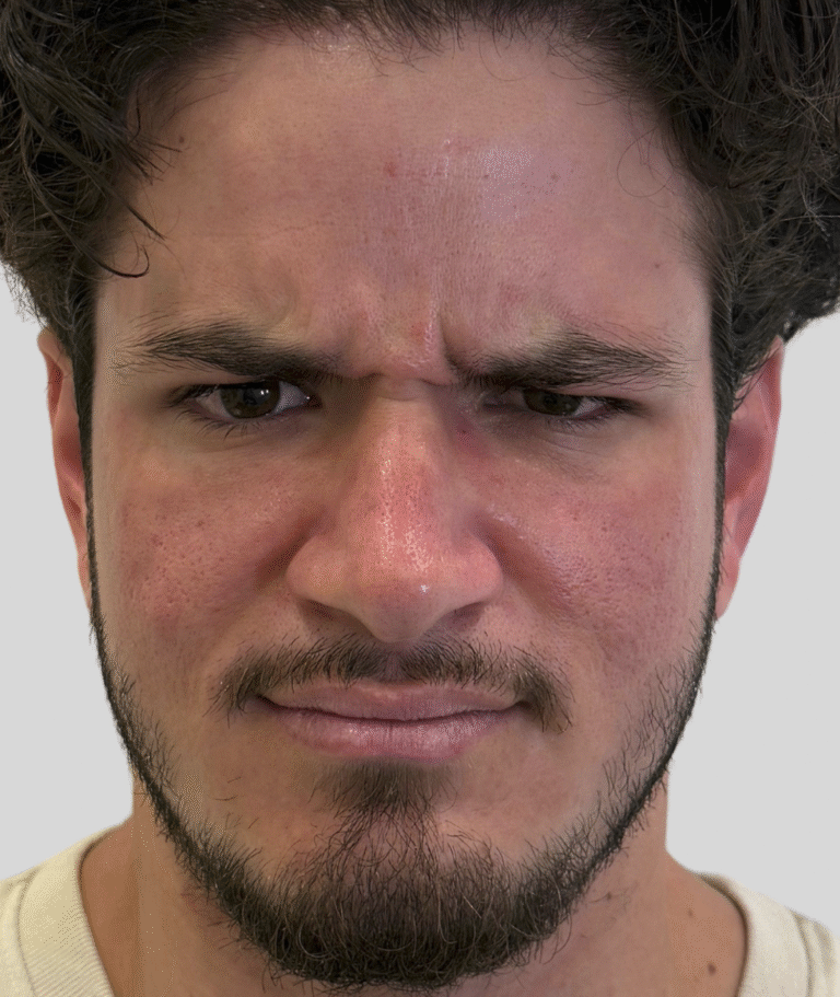 Before Image: Xeomin - front