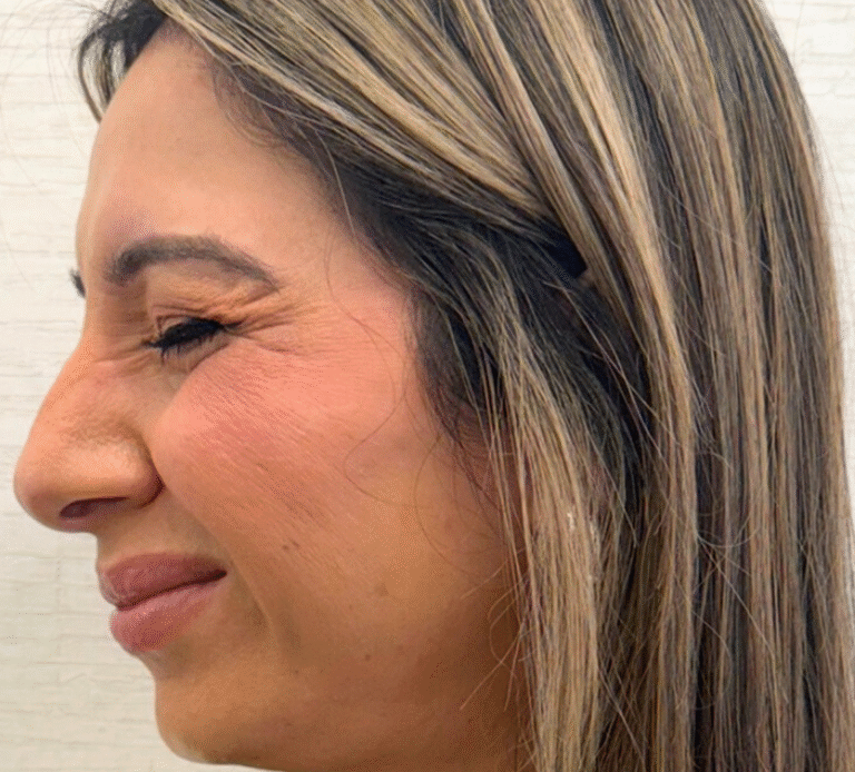 Before Image: Xeomin - left-front-oblique