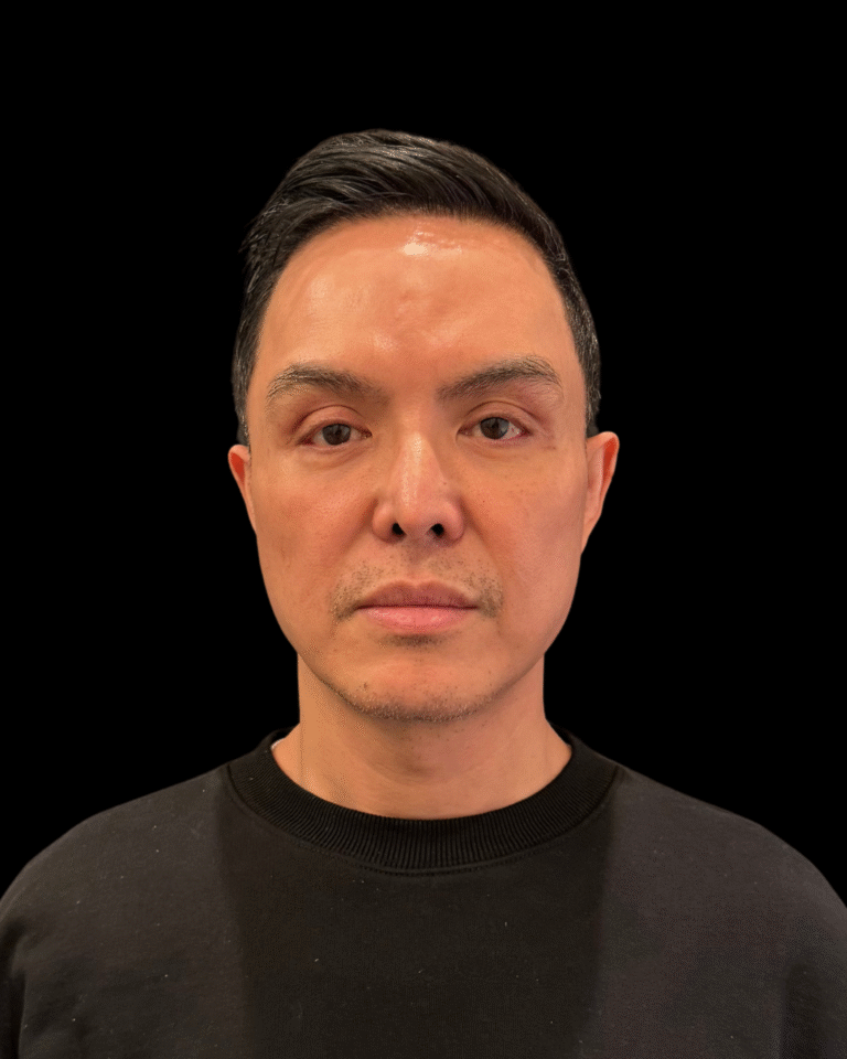 After Image: Ultherapy PRIME - front
