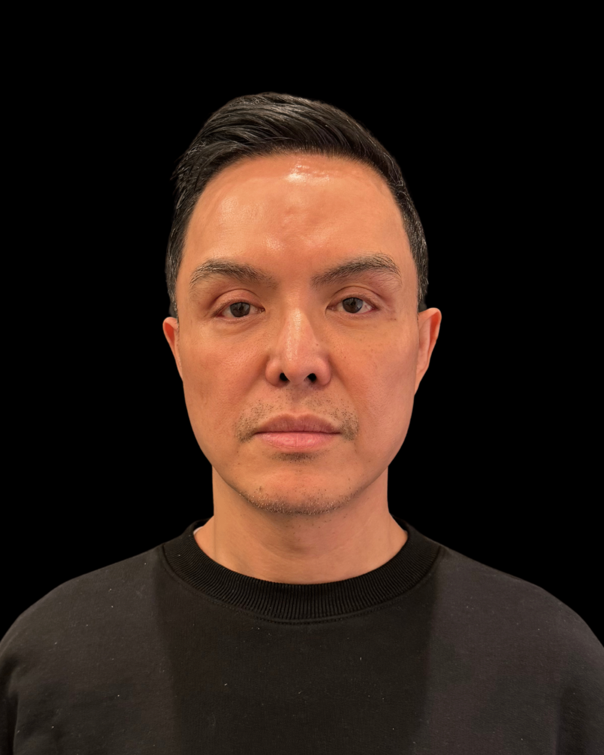 After Image: Ultherapy PRIME - front